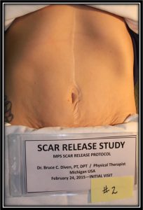 Scar Release Therapy